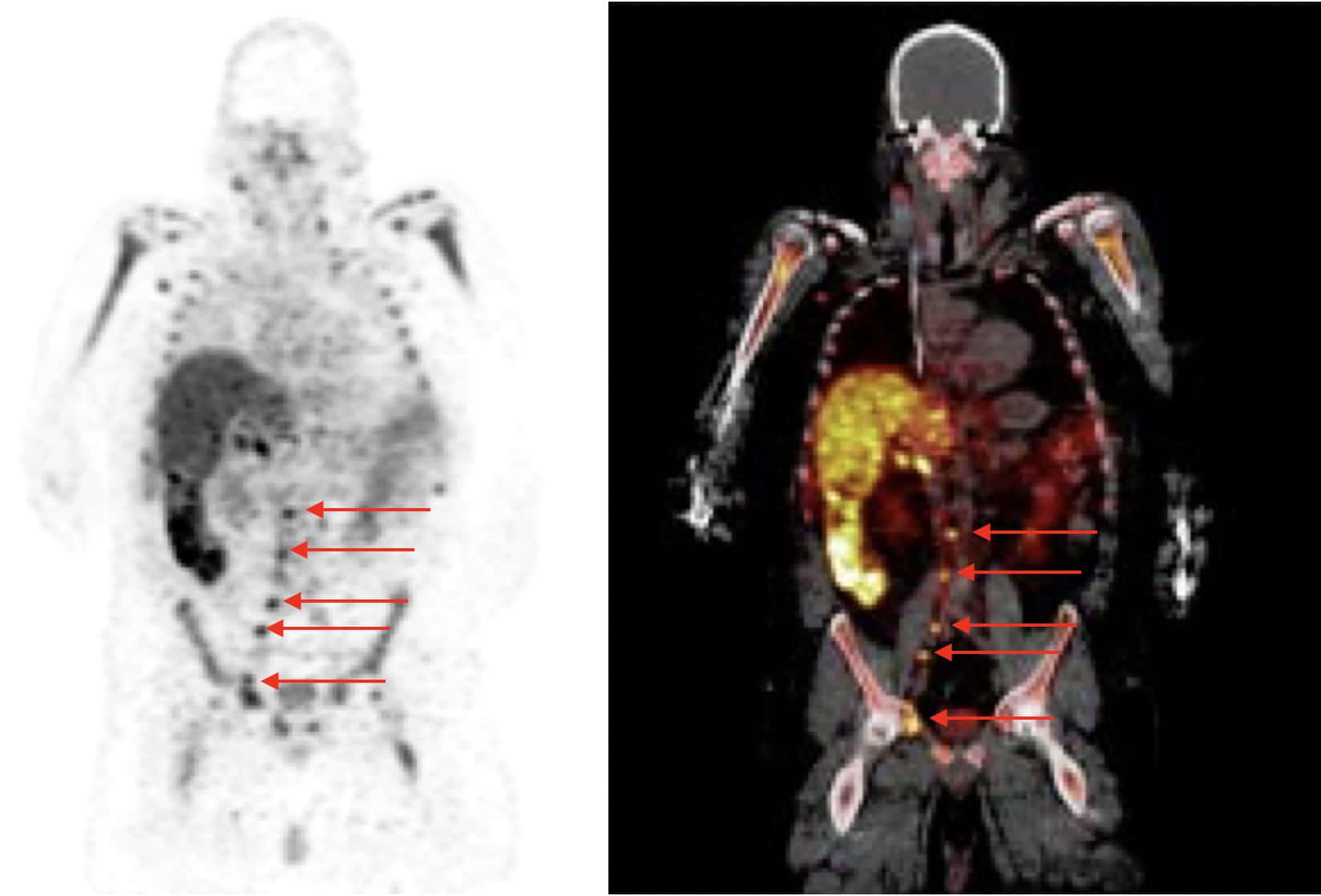 Patient CD8 PET scan