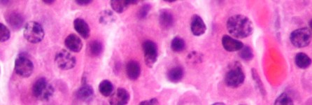 Multiple myeloma cells