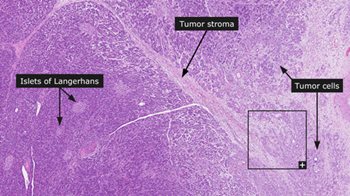histology slide showing pancreatic cancer cells and tumor stroma
