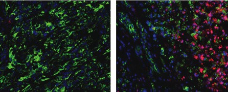 On the left, Gr-MDSCs (green) prevent killer T cells (red) from entering the tumor; on the right, depleting the Gr-MDSCs allows the killer T cells to mount an attack