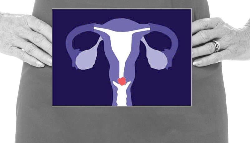 Cervical cancer location illustration