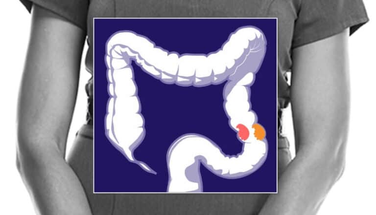 Colorectal cancer location illustration