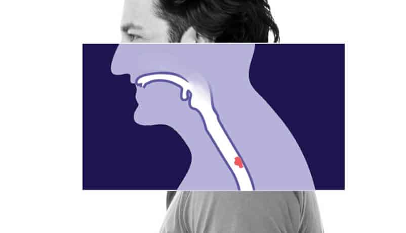 Esophageal cancer location illustration