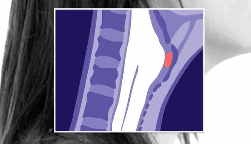 Head Neck cancer location illustration