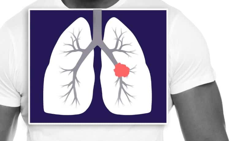 Lung cancer location illustration