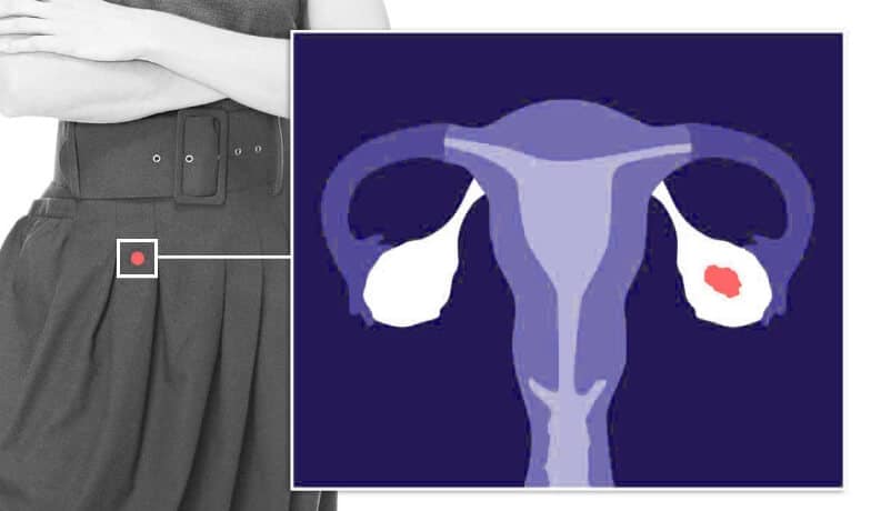 Ovarian cancer location illustration