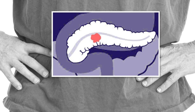 Pancreatic cancer location illustration