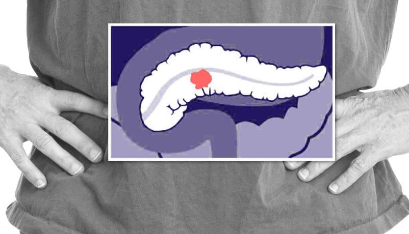 immunotherapy for pancreatic cancer location illustration