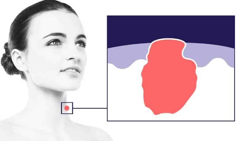 Skin cancer location illustration