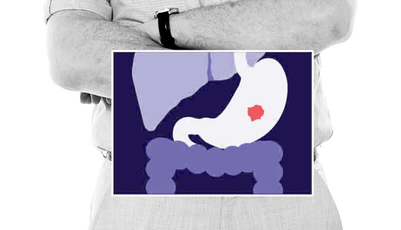 immunotherapy for stomach cancer location illustration