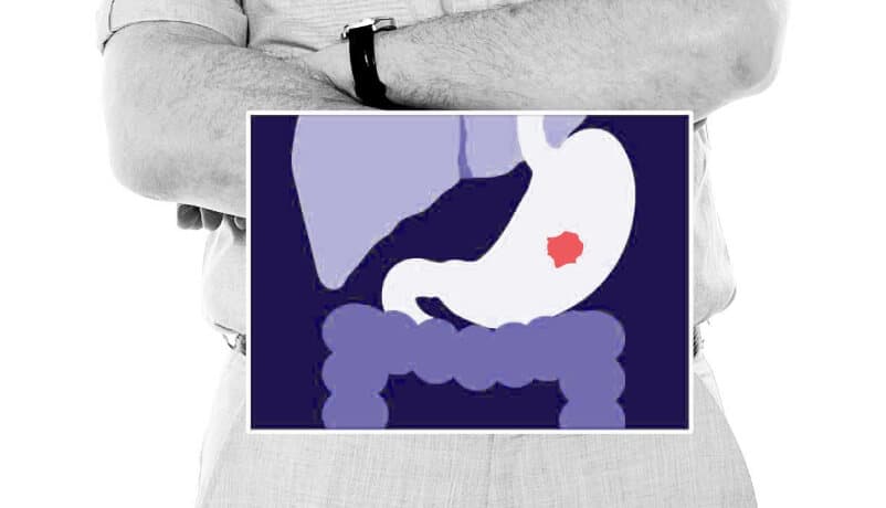 Stomach cancer location illustration