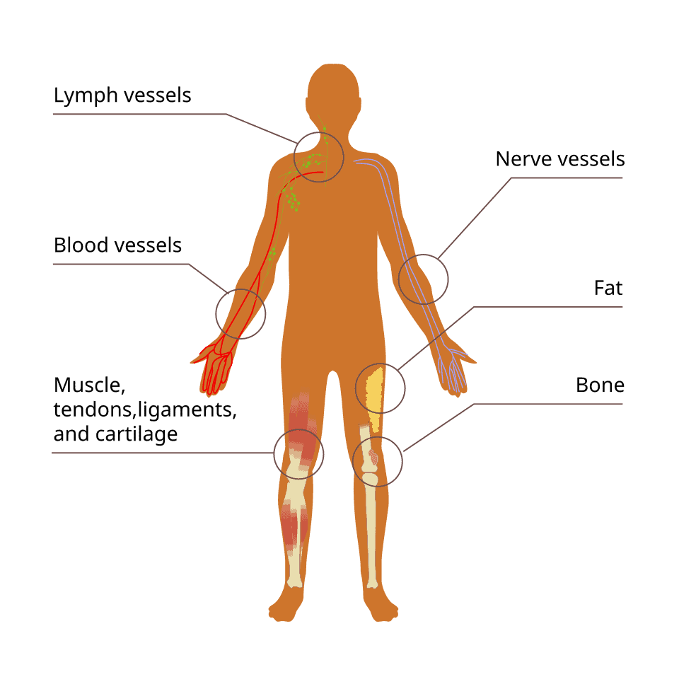 What Patients Should Know About Sarcoma and Immunotherapy